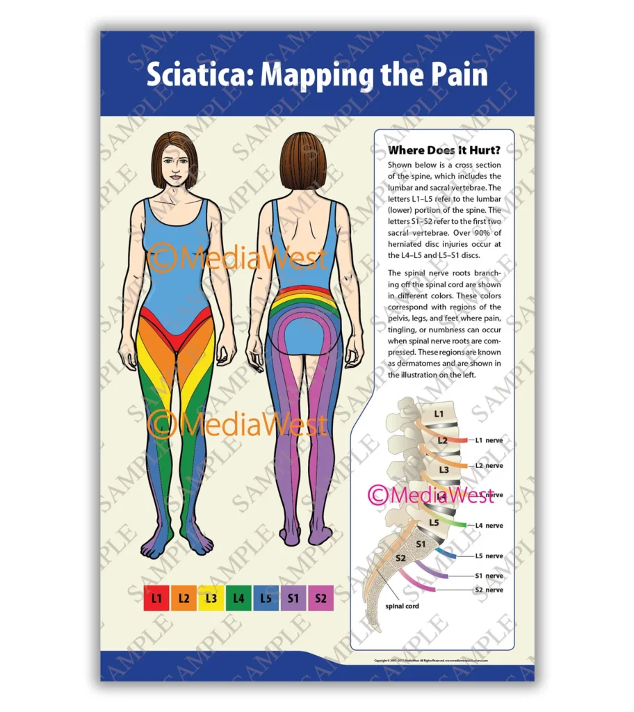 photo-thumbnail-posters-v1-sciatica